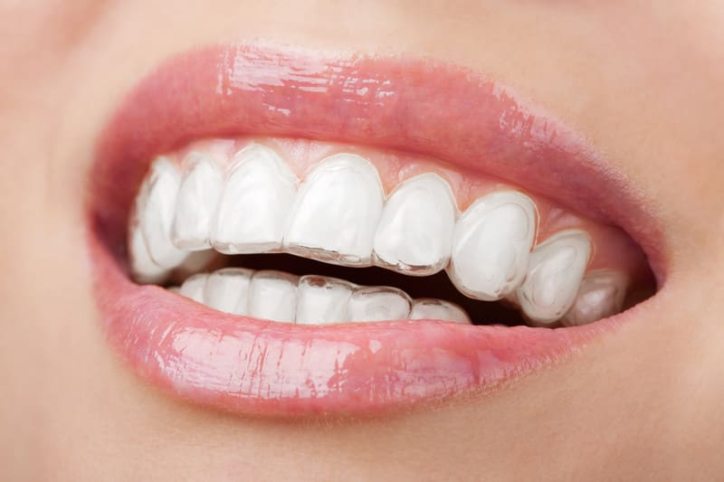 DOCS Dental Invisalign