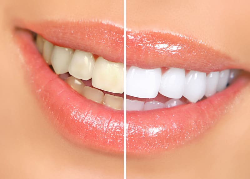 Teeth Whitening Services